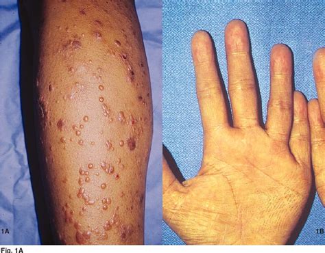 tapping your shin cirrhosis|pictures of cirrhosis skin.